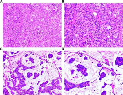 Case report: Clinical management of recurrent small cell lung cancer transformation complicated with lung cancer-induced acute pancreatitis after lung adenocarcinoma surgery